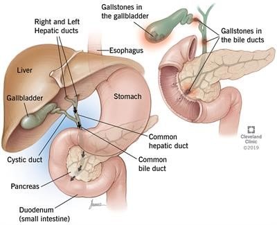 Calculos Biliares Sintomas Y Causas Mayo Clinic